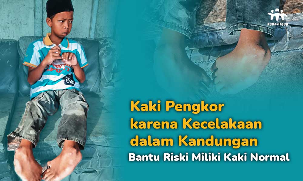 Kaki Pengkor Sejak Lahir, Beri Riski Harapan untuk Bisa Berjalan