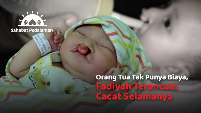 Bantu Fadiyah Bayi dengan Kelainan Bibir Sumbing