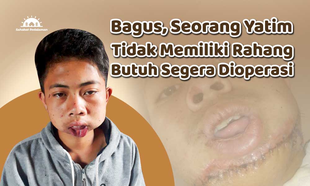 Bagus Harus Dioperasi Rahang Segera!