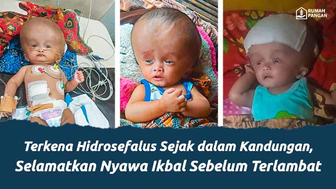 Hidrosefalus Sejak dalam Kandungan, Selamatkan Nyawa Ikbal Sebelum Terlambat