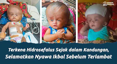 Hidrosefalus Sejak dalam Kandungan, Selamatkan Nyawa Ikbal Sebelum Terlambat