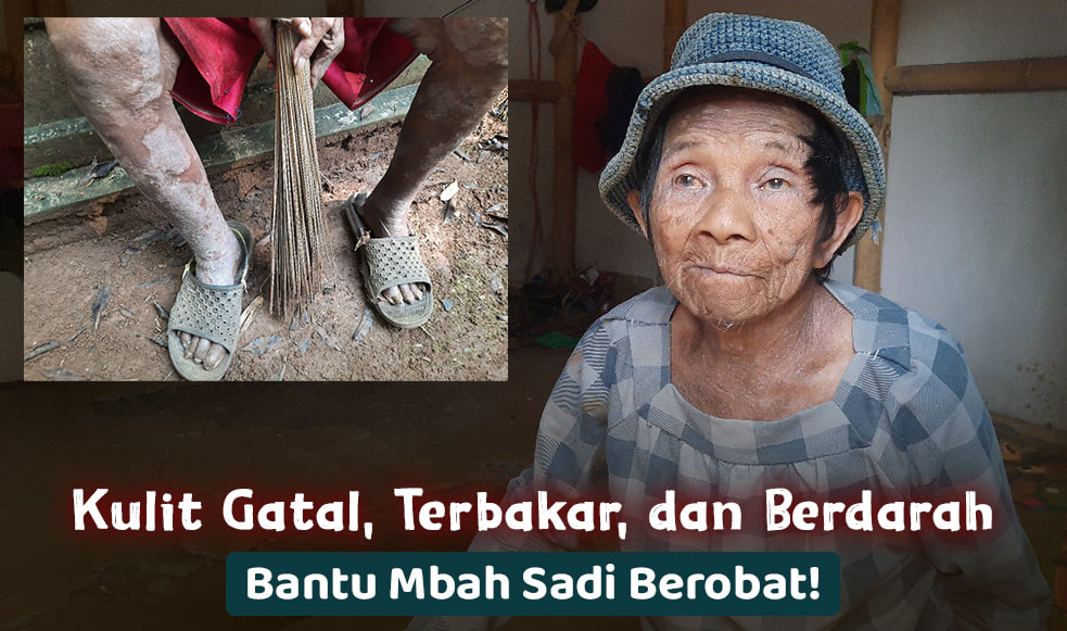 Kehilangan Pekerjaan Karena Penyakit Kulit, Mbah Sadi Ingin Berobat!