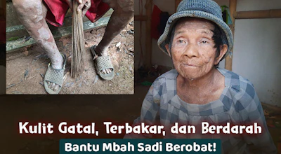 Kehilangan Pekerjaan Karena Penyakit Kulit, Mbah Sadi Ingin Berobat!