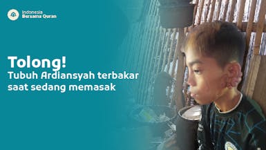 Yatim Piatu, Ardiansyah Butuh Bantuan tuk Obati Luka Bakarnya