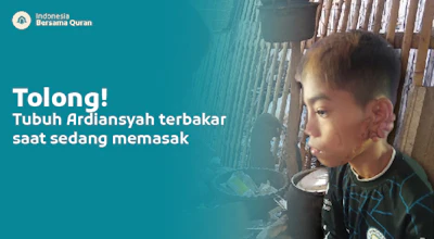 Yatim Piatu, Ardiansyah Butuh Bantuan tuk Obati Luka Bakarnya