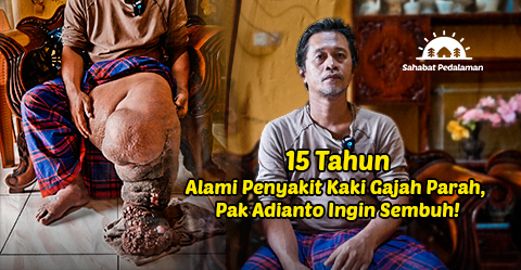 Kaki Terus Membesar, Bantu Pak Adianto Sembuh