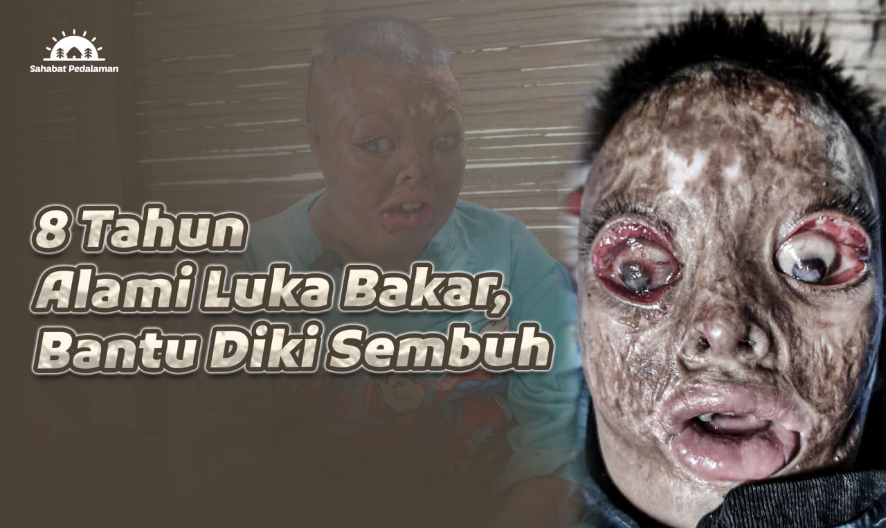 Wajah Alami Luka Bakar, Diki Harus Dioperasi