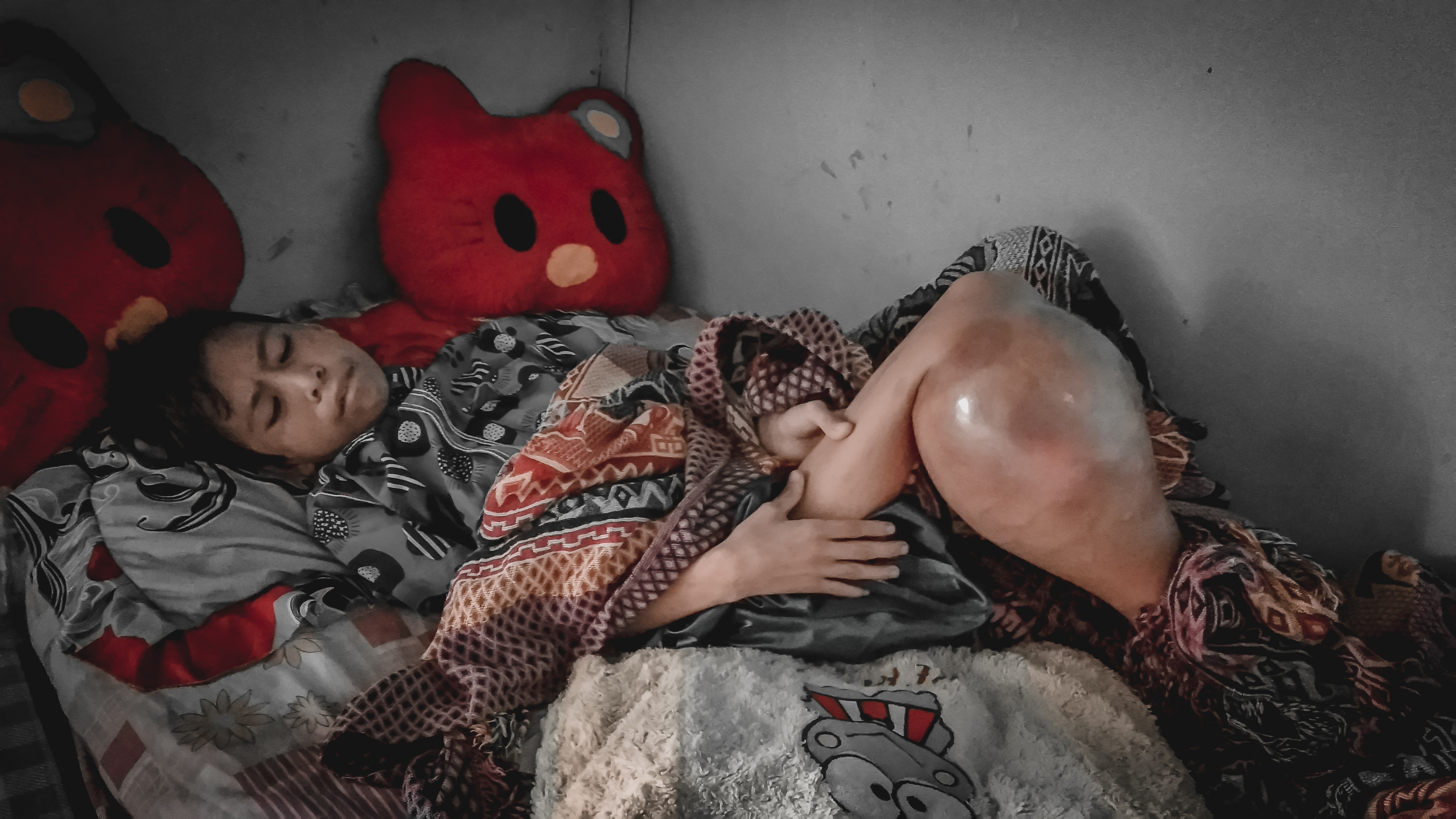 Terancam Amputasi ! Bantu Anak Yatim Untuk Sembuh Dari Kanker Tulang Ganas