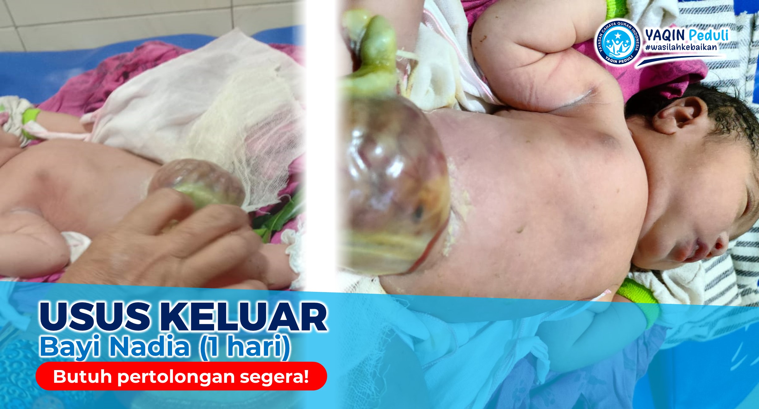 Urgent ! Usus keluar dari perut bayi Nadia