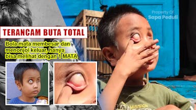 TERANCAM BUTA TOTAL! Karena glaucoma, hanya 1 mata tersisa
