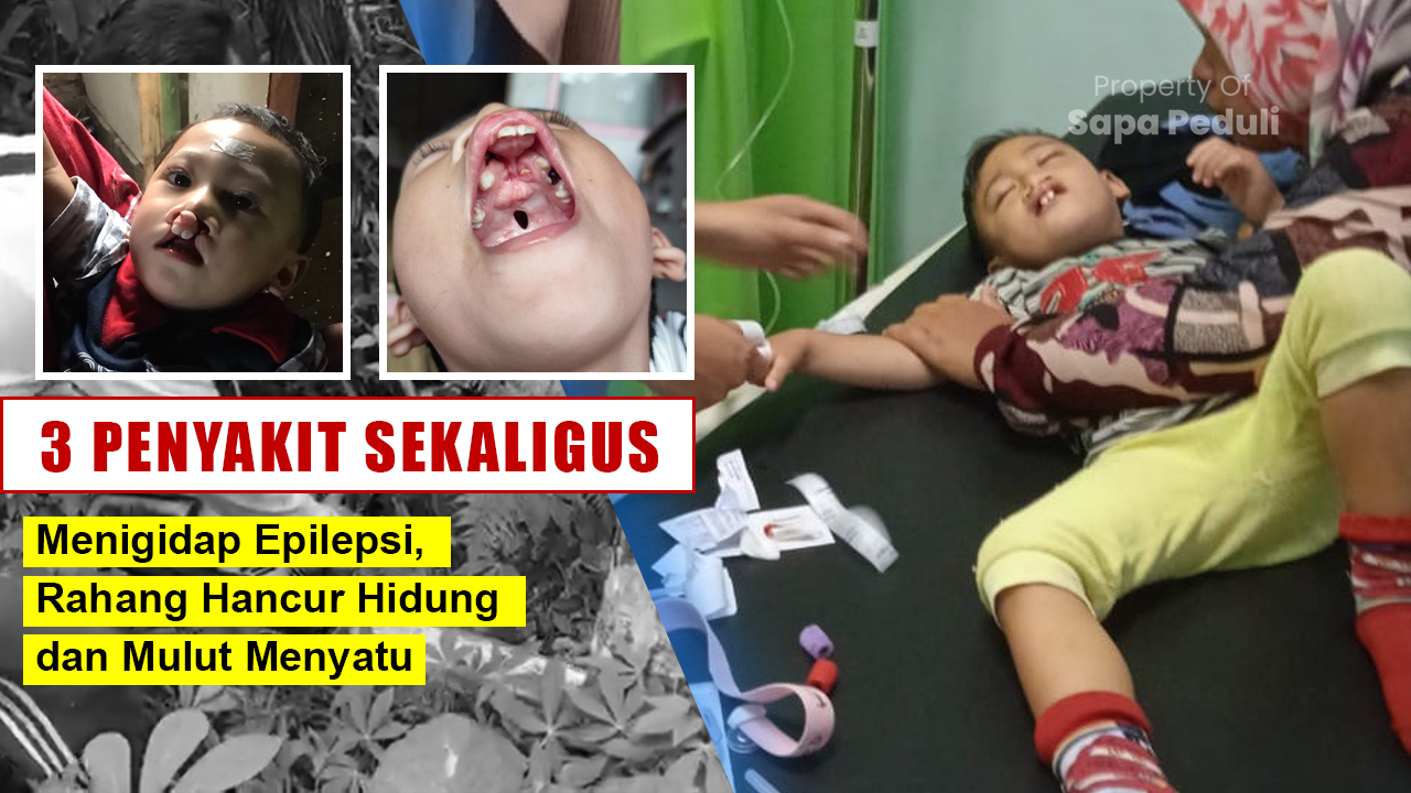 URGENT! Sudah sakit Epilepsi, Rahang Hancur Hidung dan Mulut Menyatu