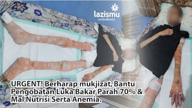 URGENT! Berharap mukjizat, Bantu Pengobatan Luka Bakar Parah 70% dan Mal Nutrisi Serta Anemia.