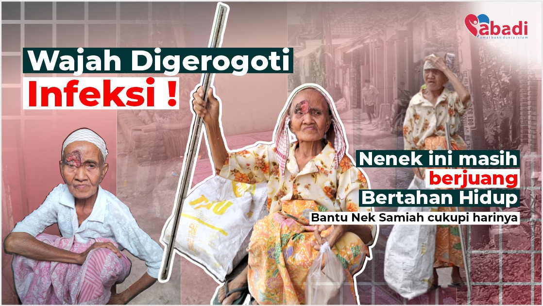 Miris! Infeksi Parah, Sebelah Matanya Hampir Membusuk