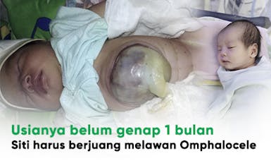 Organ Tubuh Keluar Melalui Pusar, Bantu Bayi Siti Lawan Omphalocele
