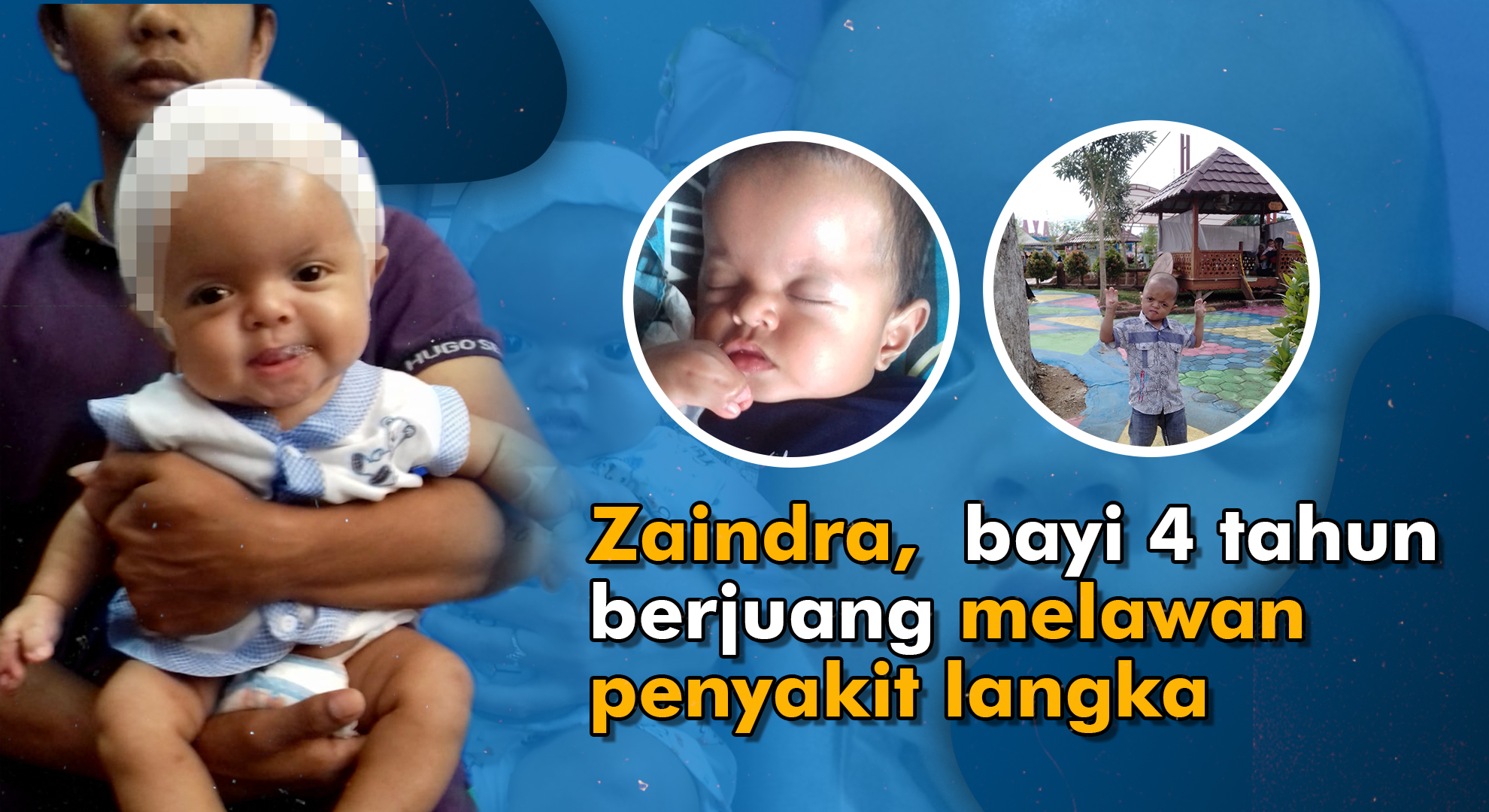 Bantu Zaindra, Balita 4 Tahun Berjuang Melawan Penyakit Langka