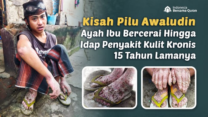 Jadi Tukang Parkir Demi Nenek yang Lumpuh, Bantu Awaludin Sembuh dari Penyakit Kulit Kronis