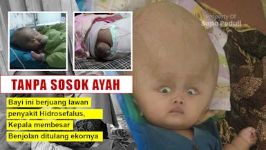 TANPA AYAH! Bayi Putri Berjuang Lawan Hidrosefalus, pembesaran kepala dan Benjolan