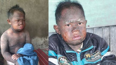 Kulit Bersisik bak Ikan, Aziz sering di Buly dan di Kucilkan