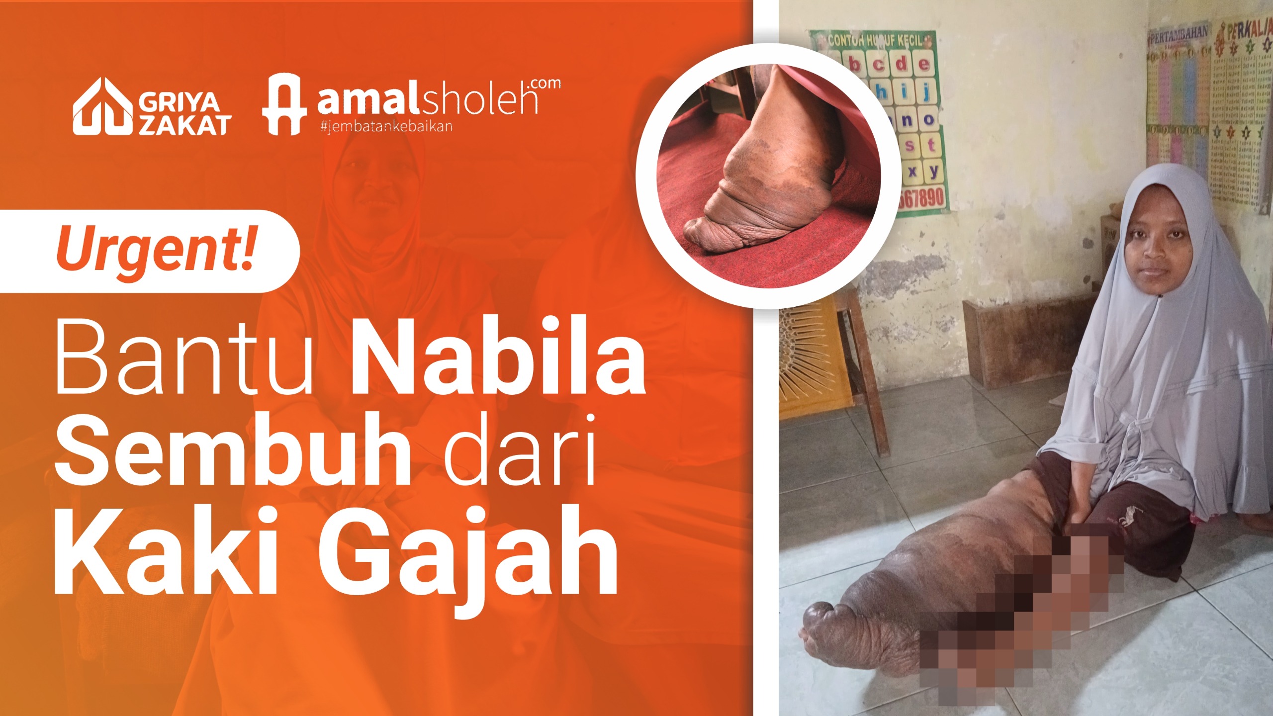URGENT! Bantu Operasi "Kaki Gajah" Nabila
