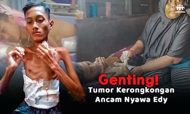 Genting! Tumor Kerongkongan Ancam Nyawa Edy