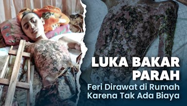 Gawat! 90% Tubuh Feri Terkena Luka Bakar