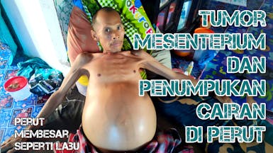 Tumor Mesenterium. Perut Pak Nawawi membesar seperti LABU
