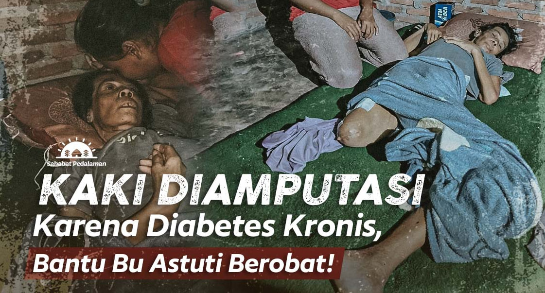 Kaki Diamputasi Karena Diabetes Kronis, Bantu Bu Astuti Berobat!