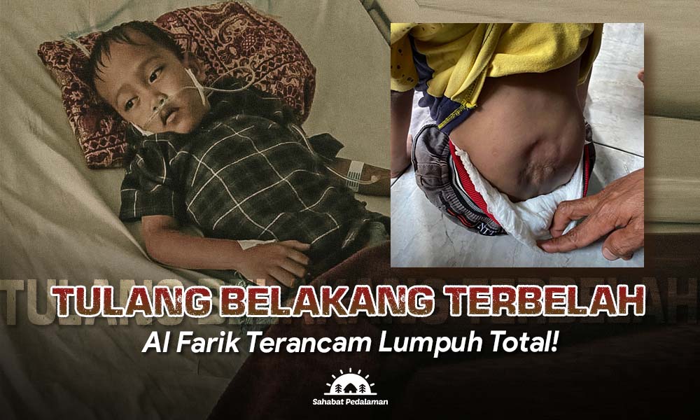 Bantu Al Farik Sembuh dari Spina Bifida dan Hidrosefalus