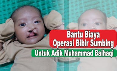 Bantu Operasi Sumbing Ananda Baihaqi, Anak Panti Asuhan Amal Islam