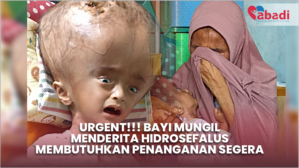 Bayi Mungil Menderita Hidrosefalus, Butuh penanganan segera!