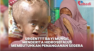 Bayi Mungil Menderita Hidrosefalus, Butuh penanganan segera!