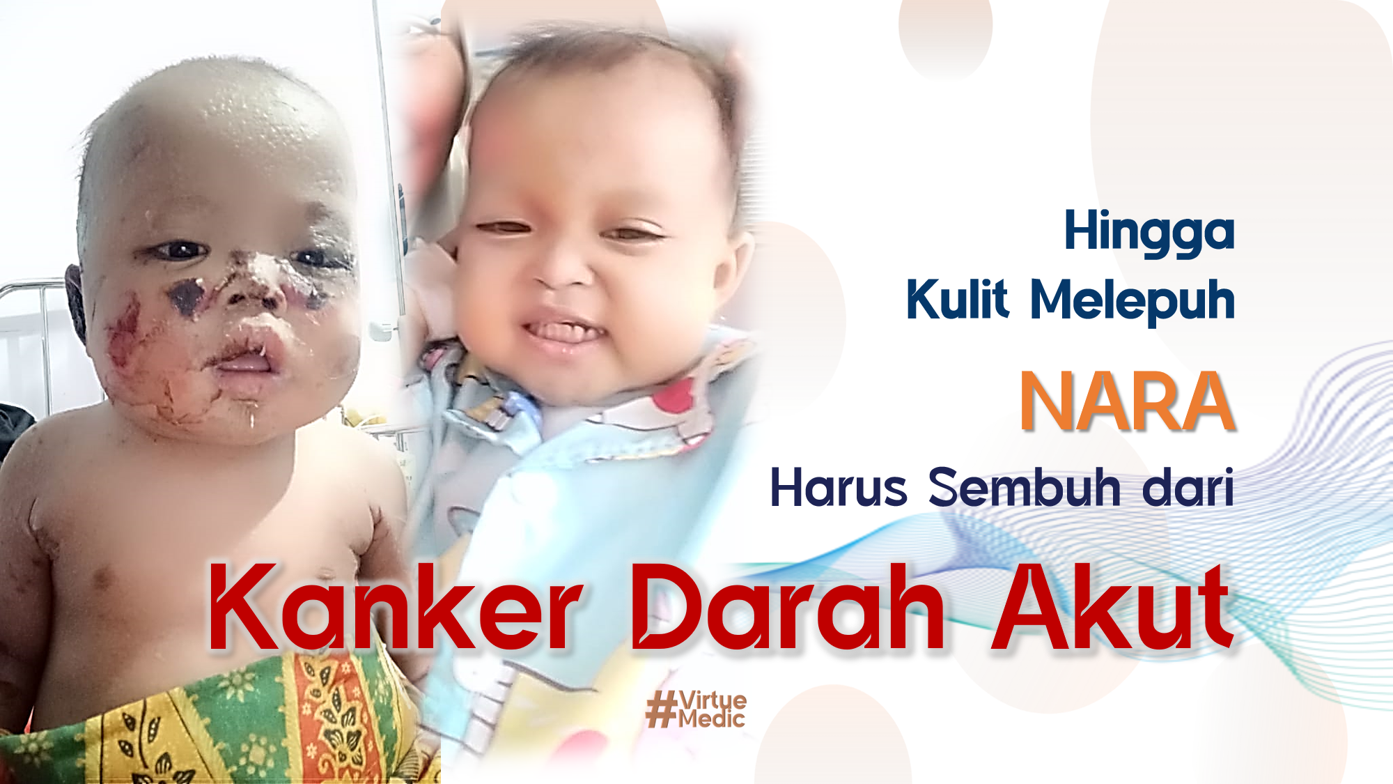 Kulit Melepuh..!!! Nara tetap harus jalani Kemoterapi Kanker Darah