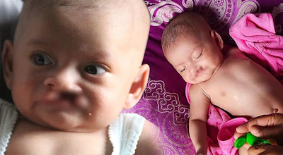 Berjuang Melawan Bibir sumbing, Bilqis juga ditinggal Sang Ayah