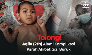 Tolong! Aqila (2th) Alami Komplikasi Parah Akibat Gizi Buruk