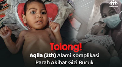 Tolong! Aqila (2th) Alami Komplikasi Parah Akibat Gizi Buruk