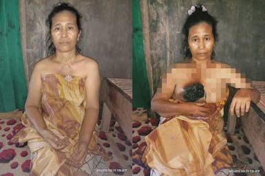 Selama 4 tahun, Ibu Ani selalu merintih karena Kanker Payudaranya tak pernah diobati