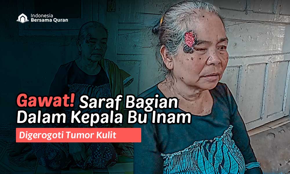 Tumor Kulit Bersarang di Kepala, Bantu Bu Inam Sembuh Segera