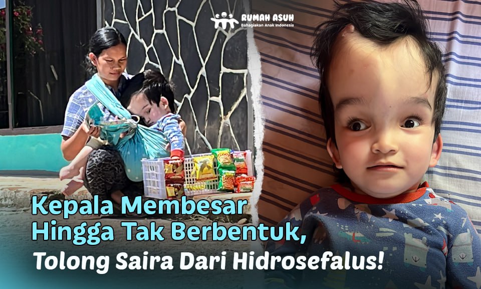 Saira, Anak Pedagang Keliling Berjuang Sembuh Dari Hidrosefalus