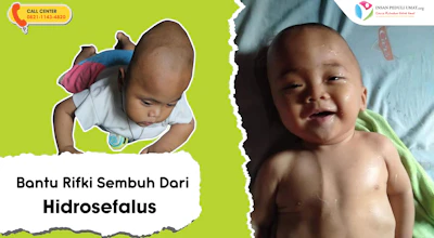 Bantu Rifki Sembuh dari Hidrosefalus