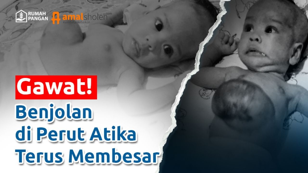 Bantu Atika Sembuh Dari Kelainan Organ Dalam