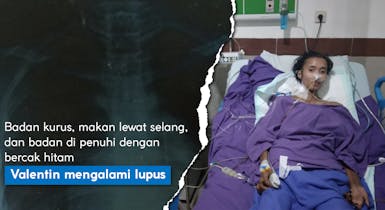 Badan kurus,Kulit Penuh Bercak Hitam dan Sulit Bernafas, Bantu Valentin Lawan Penyakit Lupus