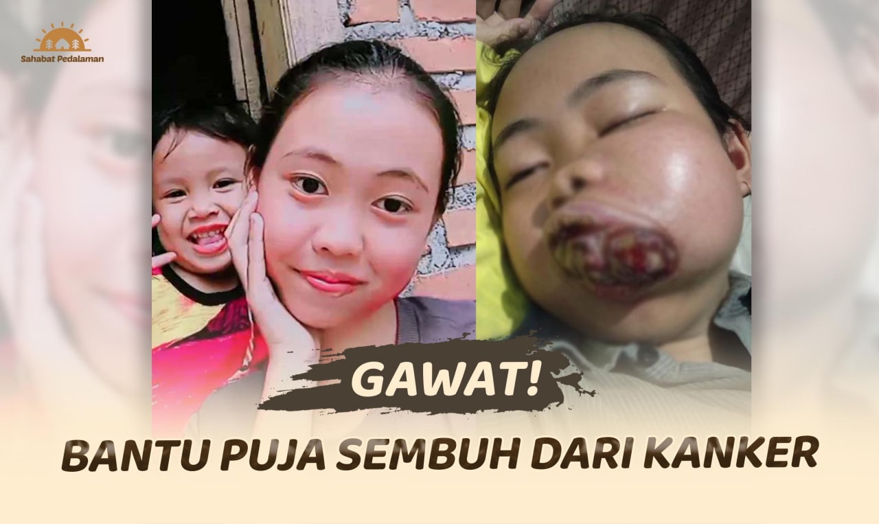 Kanker Ganas di Mulut Ancam Nyawa Puja
