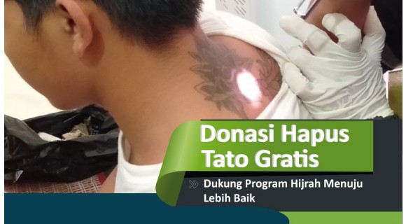 Dukung Donasi Hapus Tato Gratis, Sediakan 10 Alat Penghapus Tato