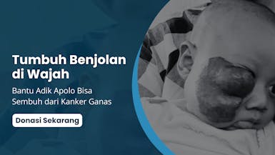 Hampir Buta, Bantu Adik Apolo Lawan Kanker Ganas
