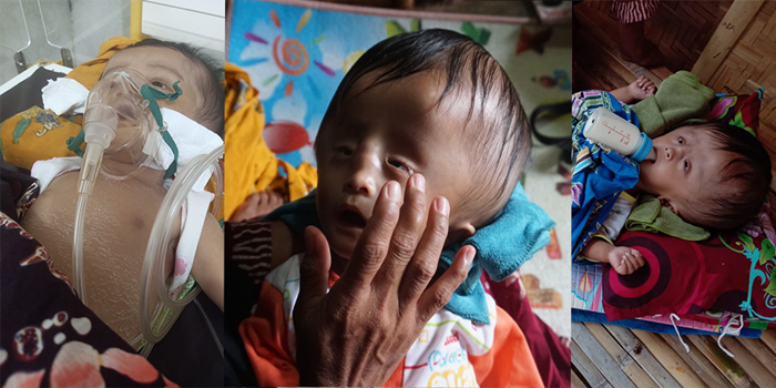 Tangis Bayi 5 Bulan Menahan Sakit Kepala Yang Membesar