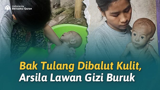 Bantu Arsila (7 bln) Berjuang Melawan Gizi Buruk