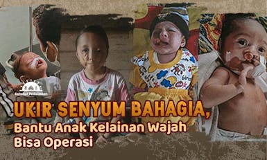 Senyum Pertama Untuk Anak Kelainan Wajah di Pedalaman