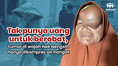 Tumor di Wajah Sebesar Bola Tenis, Bantu Nek Nengsih Sembuh!