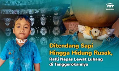 Gawat! Saluran Napas Rafli Tersumbat, Harus Segera Operasi