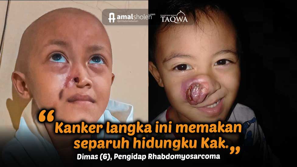 Bantu Dik Dimas Sembuh dari Kanker Langka